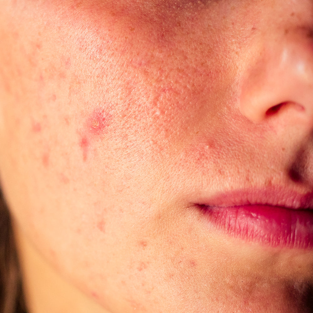 Rutina Anti-acné
